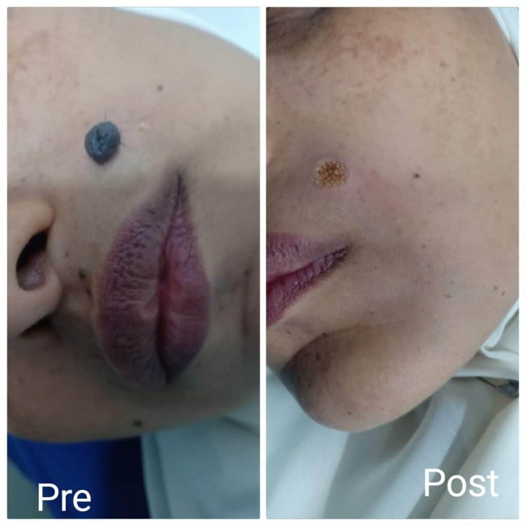 Facial skin tag removal in Hurghada